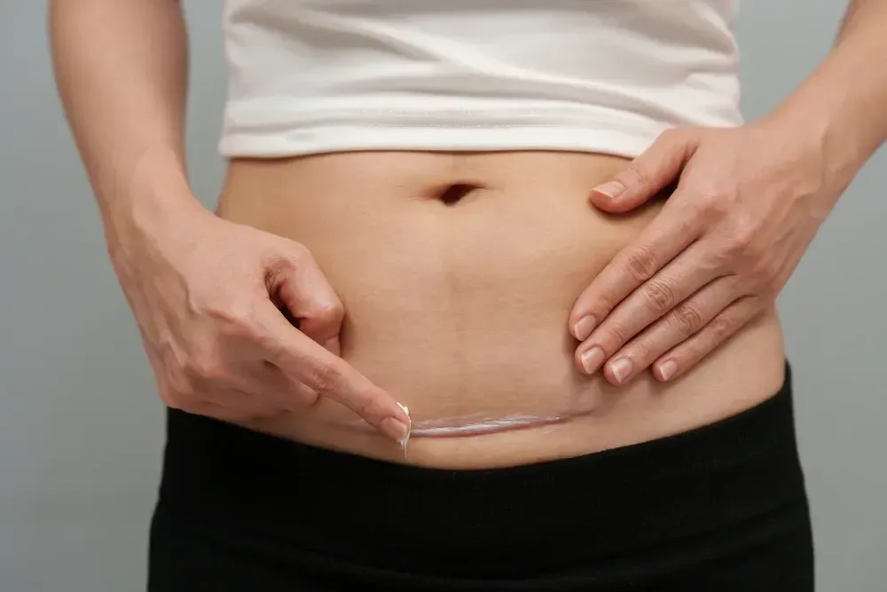 C-section scar healing process