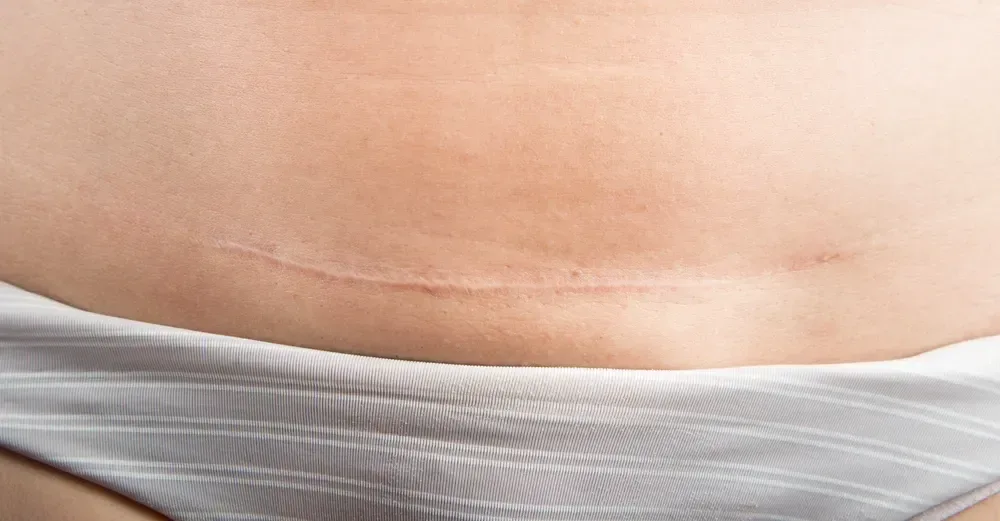 C-section scar healing