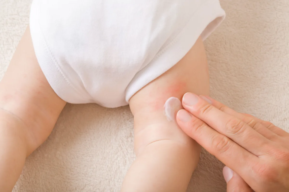 Baby Allergies