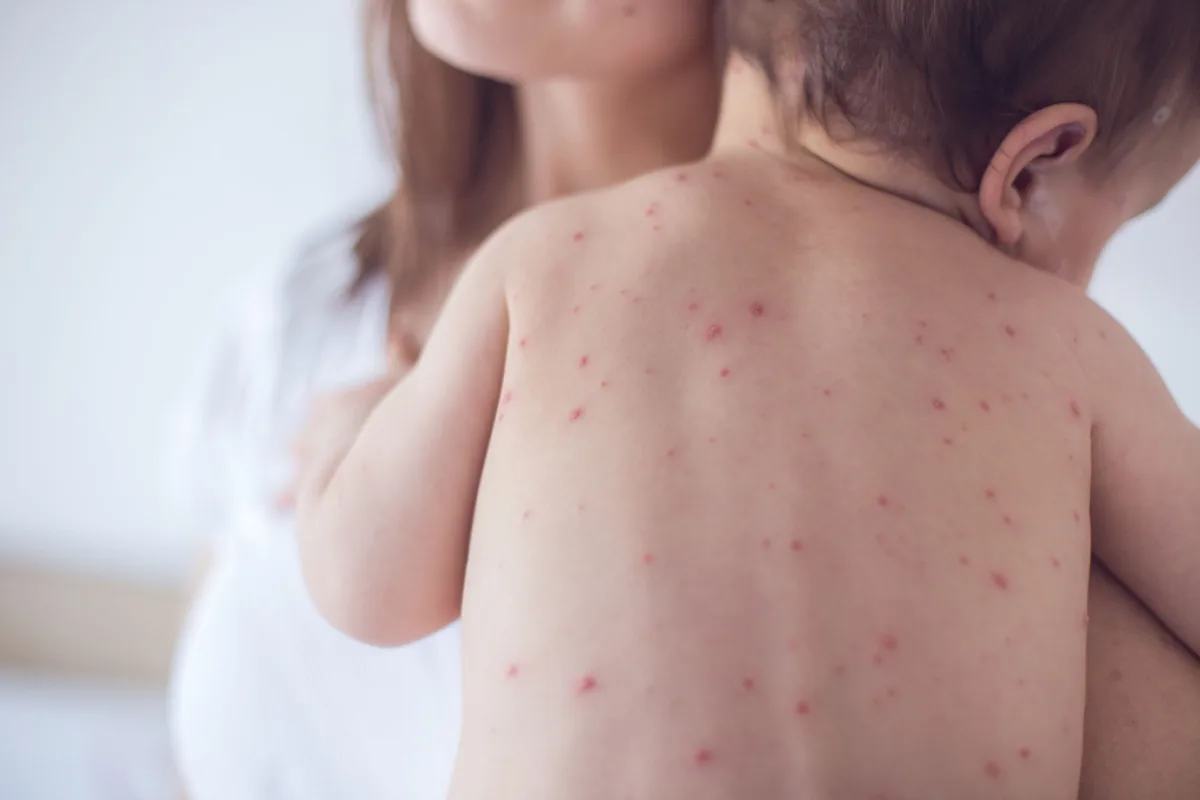 Baby Allergies