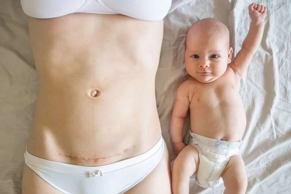 Cesarean Awareness Month